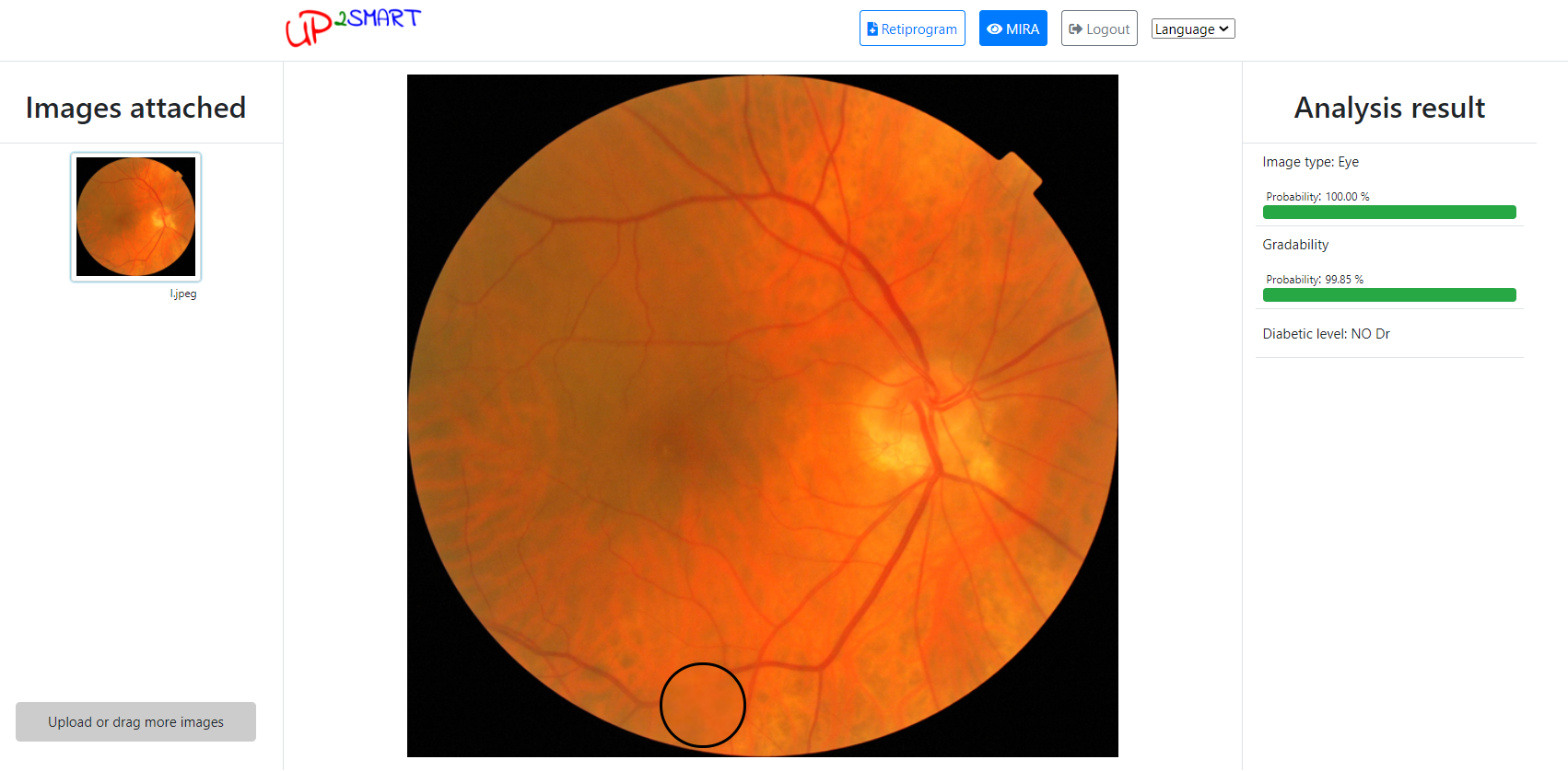 MIRA negative DR patient screenshot