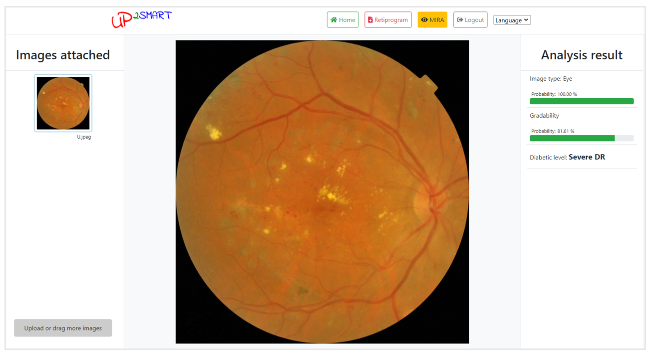 MIRA positive DR patient screenshot